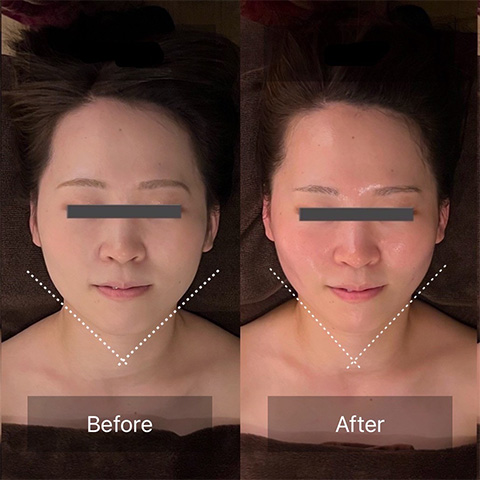 フェイスラインのたるみ・浮腫み解消