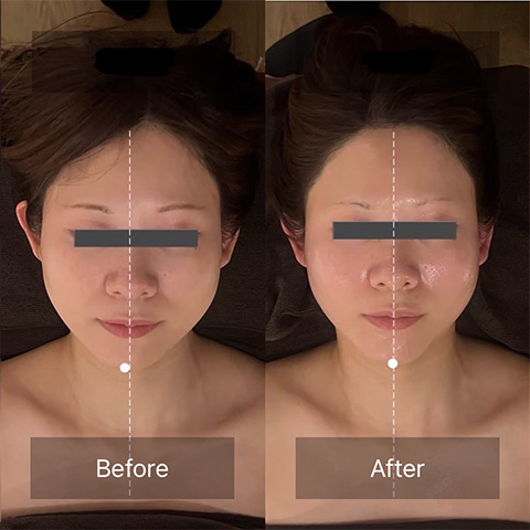 エラ張りがなくなりすっきり小顔になった女性