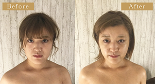 女性の施術前後の画像